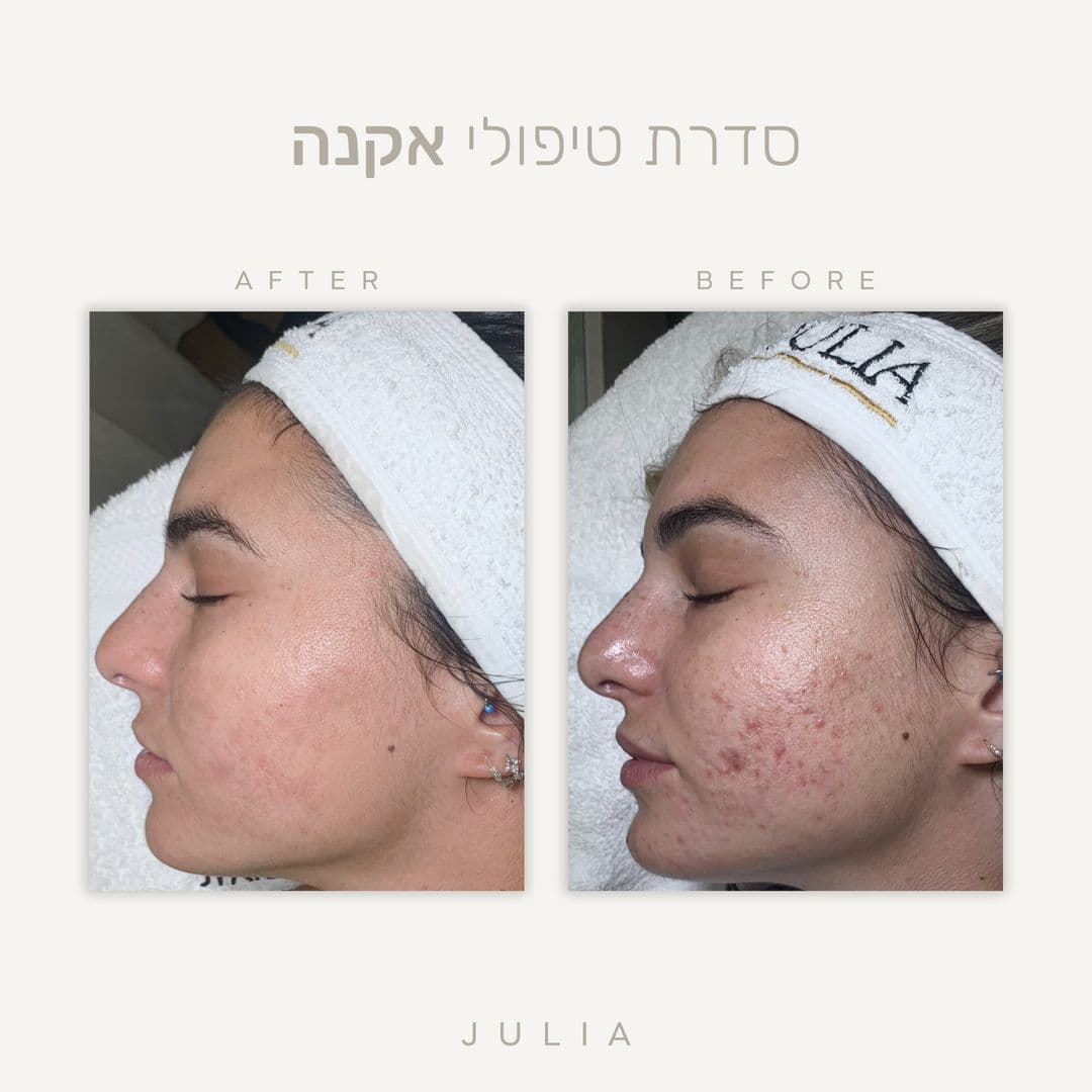 תוצאות טיפול טיפול אקנה ופוסט אקנה בראשון לציון — לפני ואחרי
