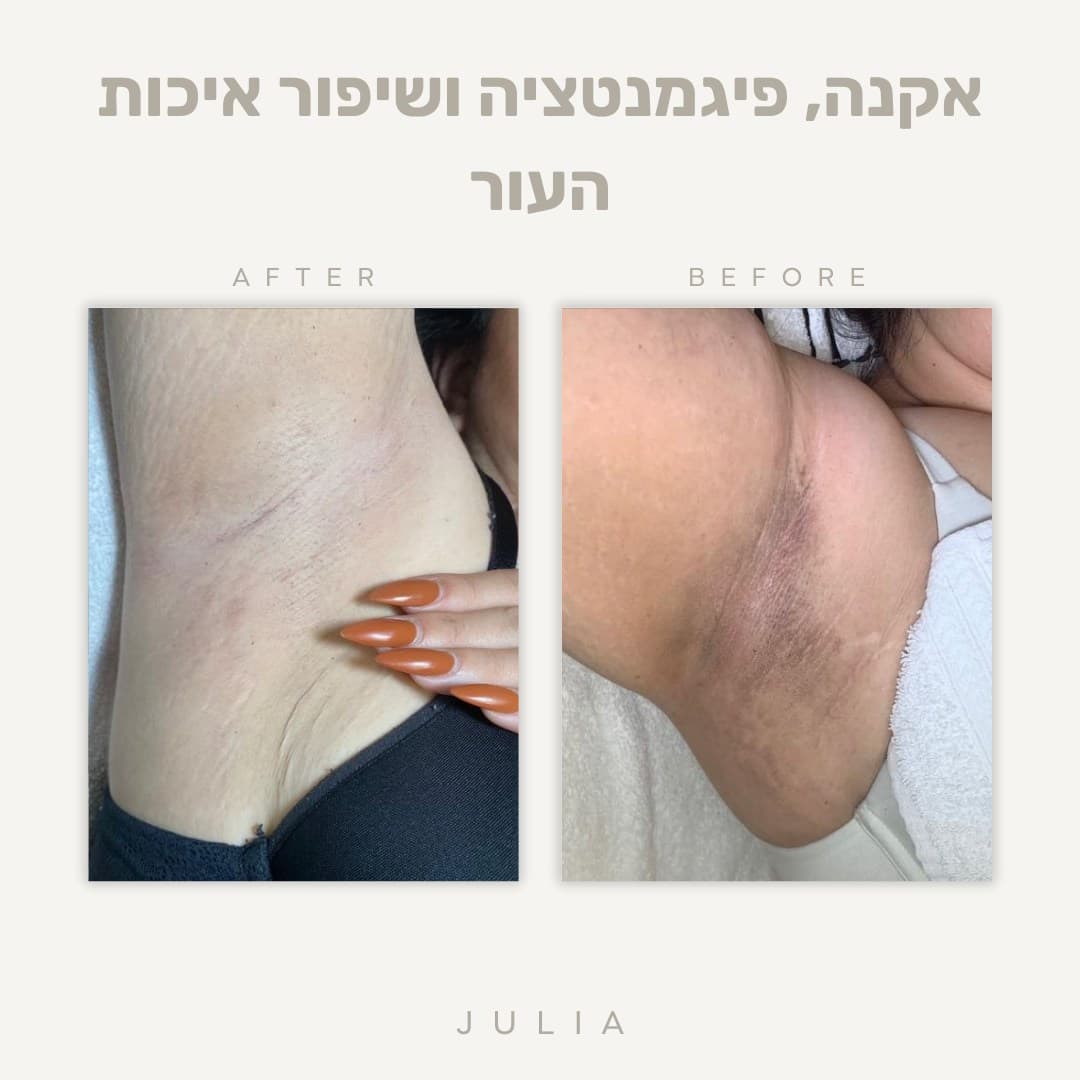 טיפול אקנה ופוסט אקנה — ג׳וליה קוסמטיקס בראשון לציון