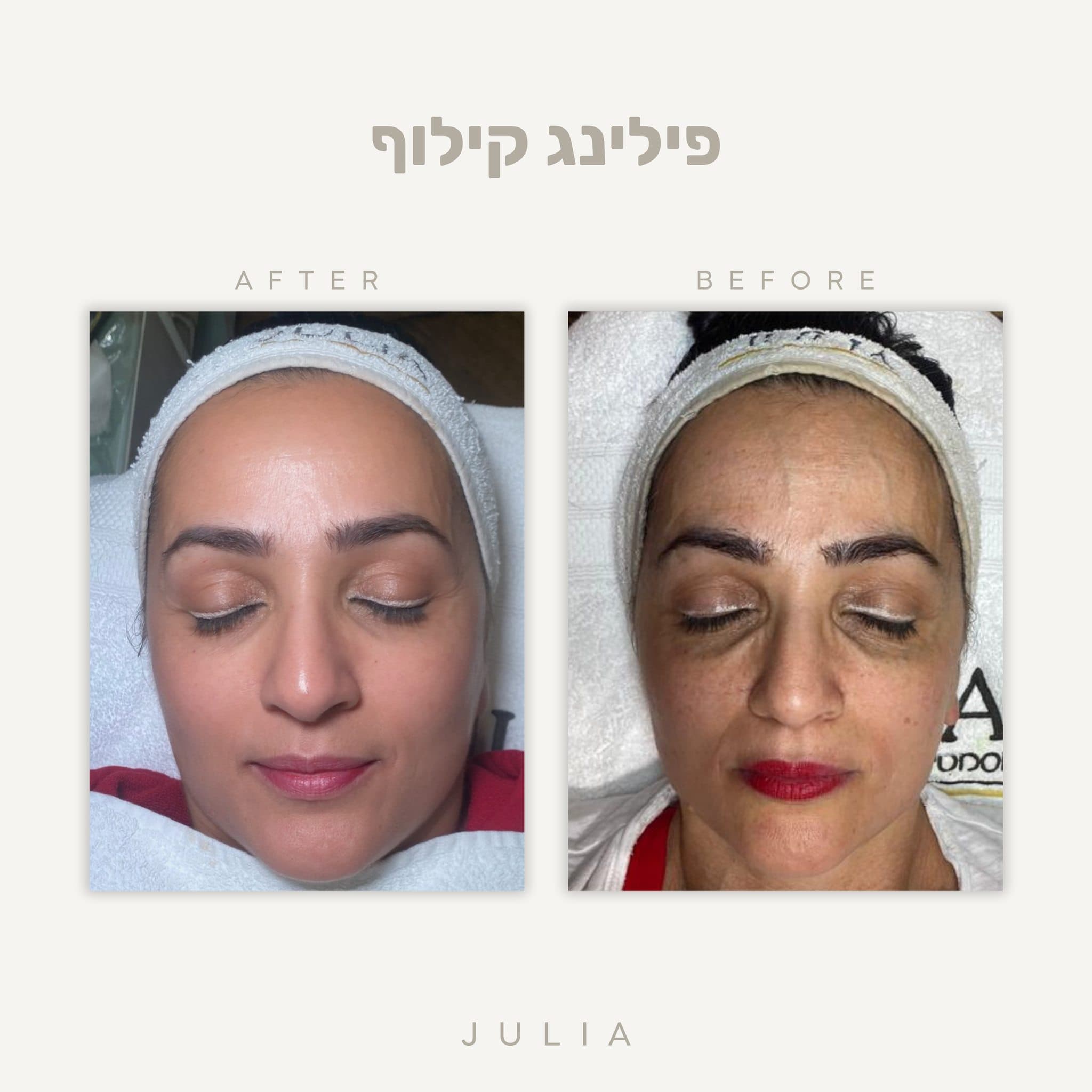 תוצאות פילינג קילוף